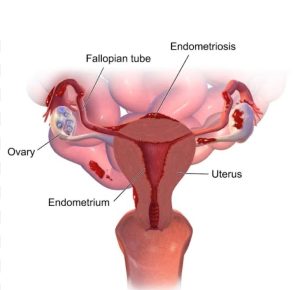 Endometriosis and Fertility