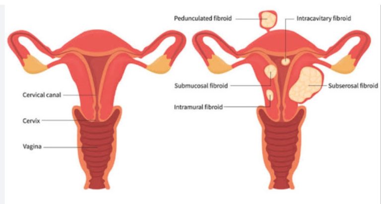 Fibroids and Fertility