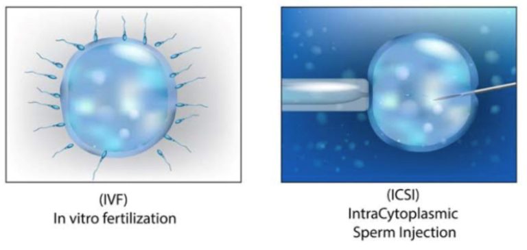 Understanding The Difference Betweein IVF And ICSI